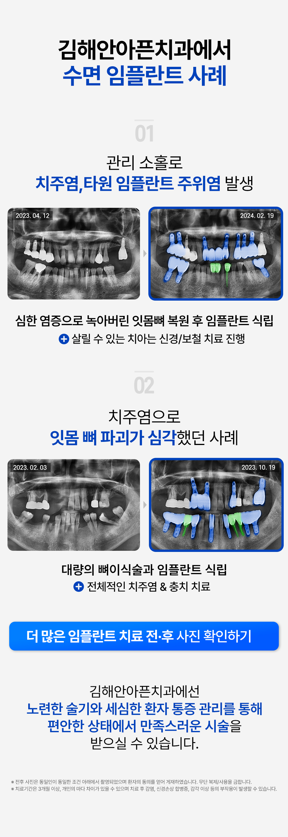 김해안아픈숙면치과 수면 임플란트 사례