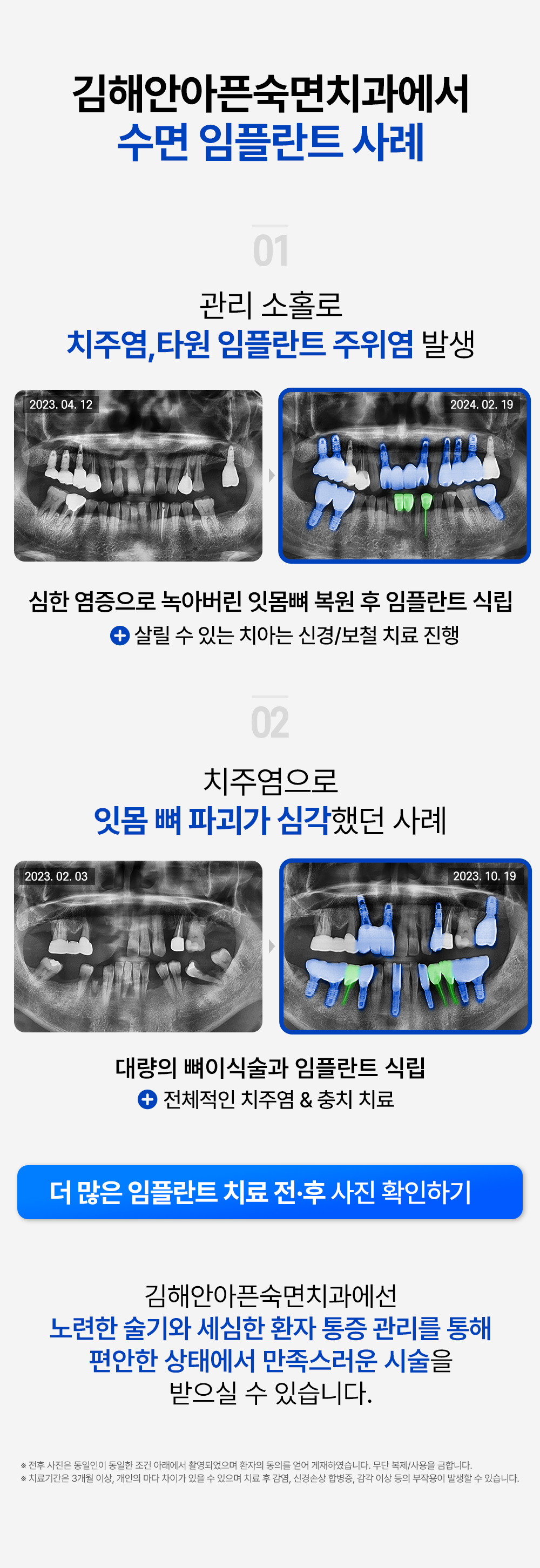 김해안아픈숙면치과 수면 임플란트 사례